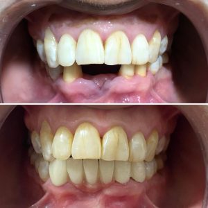 dentiste et blanchiment des dents à Ksour Essef