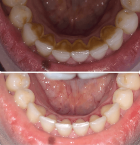 Bridge dentaire et détartrage chez dentiste Ksour Essef