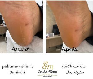 Soins de pédicurie médicale chez Souhir Mhiri podologue Ksar hellal