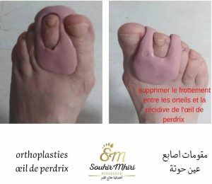 Orthoplasties et œil de perdix avec soin du pied diabétique à Ksar Hellal