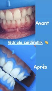 blanchiment et soins esthétiques dentaire à Sfax