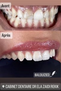 Bridge et couronne en zircone chez dentiste Sfax Dr Ela Zadi