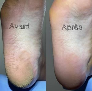 podologue sousse soin avant après des pieds