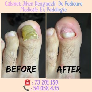 soin du pied et des ongles chez podologue Sousse Denguezli