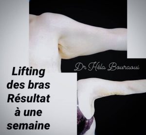 Lifting bras et chirurgie esthétique à Sousse Dr Bouraoui