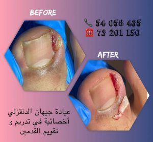Ongles incarnés et pédicure podologue Sousse Jihene Denguezli