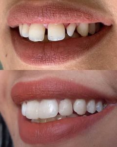 dentiste Nada Manaa - blanchiment dentaire Hammam Sousse