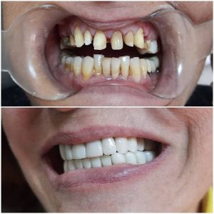 Blanchiment et détartrage dents / chirurgie dentaire à Sousse