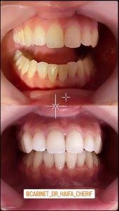 Dentiste Cherif Haifa / Blanchiment et soins gencives