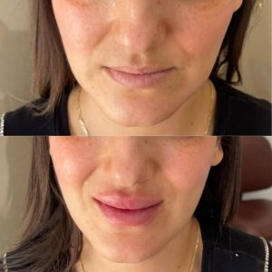 comblement lèvres et soins du visage- Dr Haj Kacem Wafa