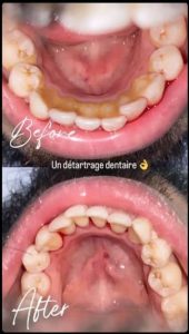 détartrage et soins caries / dentiste Hammam Sousse
