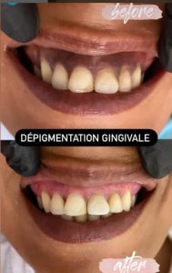 Implantologie Hammam Sousse / facette et chirurgie dentaire