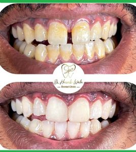dentiste-sahloul-soins-caries-detartrage Détartrage et soins caries / Dentiste Sahloul Dr Harrabi