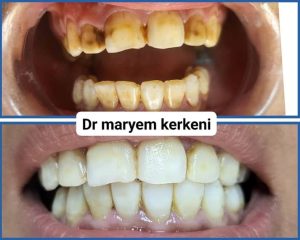 Dentiste Khezama Sousse / détartrage et blanchiment des dents