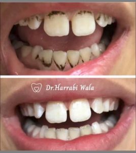 dr-harrabi-implant-dentaire-soin-gencives-sahloul prothèse et bridge dentaire à Sahloul / Dentiste Harrabi Wala