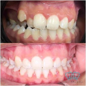 goutieres-transparentes-orthodontiste-hammam-sousse