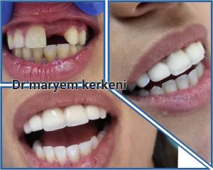 Implant et couronne dentaire - Dr Maryem Kerkeni Khezama