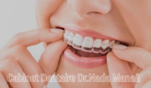 Appareil dentaire et aligneurs chez dentiste Hammam Sousse