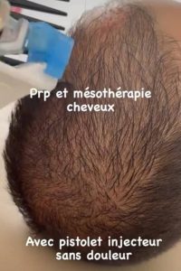 Dr Wafa Ben Haj Kacem - laser et PRP cheveux