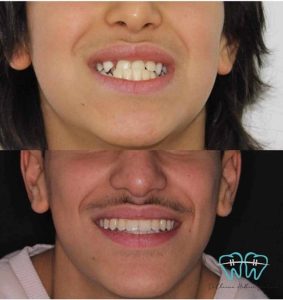 orthodontiste-aligneurs-dr-chaima-hedhiri