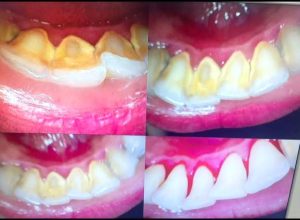 Facette et couronne dentaire chez dentiste Sirirne Zaag