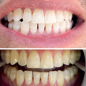 Dentiste Akouda - Blanchiment et détartrage des dents