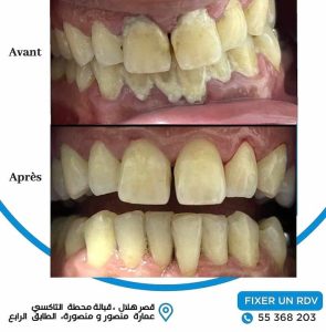 Dr Nesrine Zaag dentiste Ksar Hellal - détartrage et soins de caries