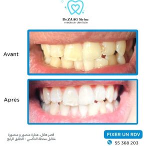 Hollywood Smile - dentiste Ksar Hellal Dr Sirirne Zaag