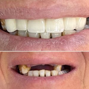 Dr Ladhari Marwa dentiste Akouda / facette et bridge dentaire