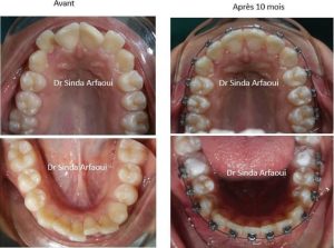 Alignement et encombrement des dents / Orthodontiste Bardo