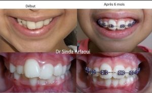 Appareil dentaire et orthodontie à Le Bardo / Dr Sinda Arfaoui