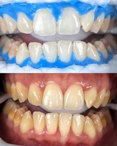 Blanchiment dentaire - Ines Hanana dentiste Ennasr 2