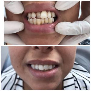 Blanchiment et implant dentaire - Dentiste Dr Amamni Toumi Sousse