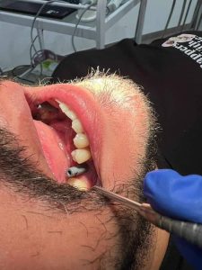 Dentiste à Ennasr 2 / Dentisterie esthétique Dr Ines Hanana