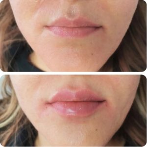 Soins du visage et des lèvres - dermatologie et laser Sousse