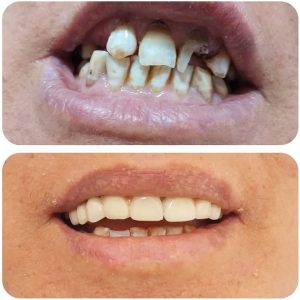 implant et prothèse à Sousse Bab Bhar / dentiste esthétique