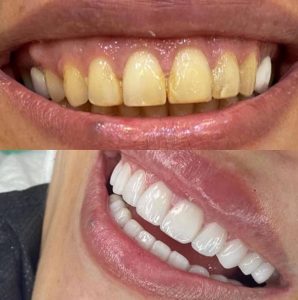 Soins dentaire et blanchiment - Dentiste Zied Ben Hamed