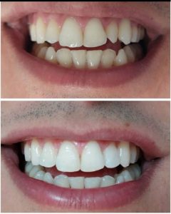 implant et détartrage - esthétique dentaire à Ennasr 2