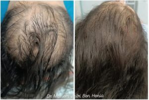 Greffe de cheveux et mésothérapie / dermatologue et laser à Sousse