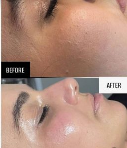 Hydrafacial et soin du visage à Khezama / Esthé belle house