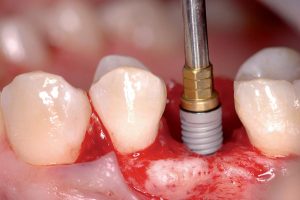 Implant dentaire à Bab Bhar Sousse - Dr Ben Hamed