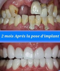 Pose d'implant dentaire à Sousse Bab Bhar - Dr Zied Ben Hamed