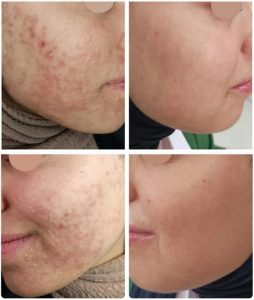 Soin des rides du visage et peau - Dermatologie à Sousse