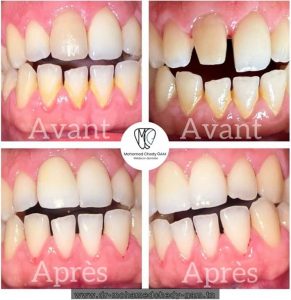 Médecin dentiste Mohamed Chedy Gam - détartrage des dents