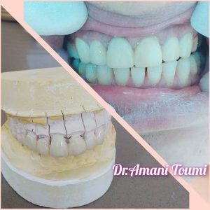 Prothèse dentaire Sousse Bahr / Dr Amani Toumi