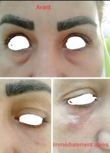 Soins des cernes et des rides du visage - laser et mésothérapie Megrine
