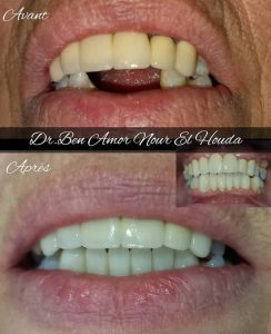 Blanchiment et chirurgie dentiare à Bardo / Dr Nour El Houda Ben Amor