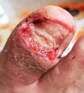 Maladies des ongles et de lapeau - Dermatologue Sousse Bab Bhar