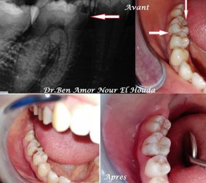 implant et prothèse dentaire - Dentiste à Bardo
