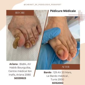 Pédicure médicale et podologie à Ariana - Ons Saadaoui